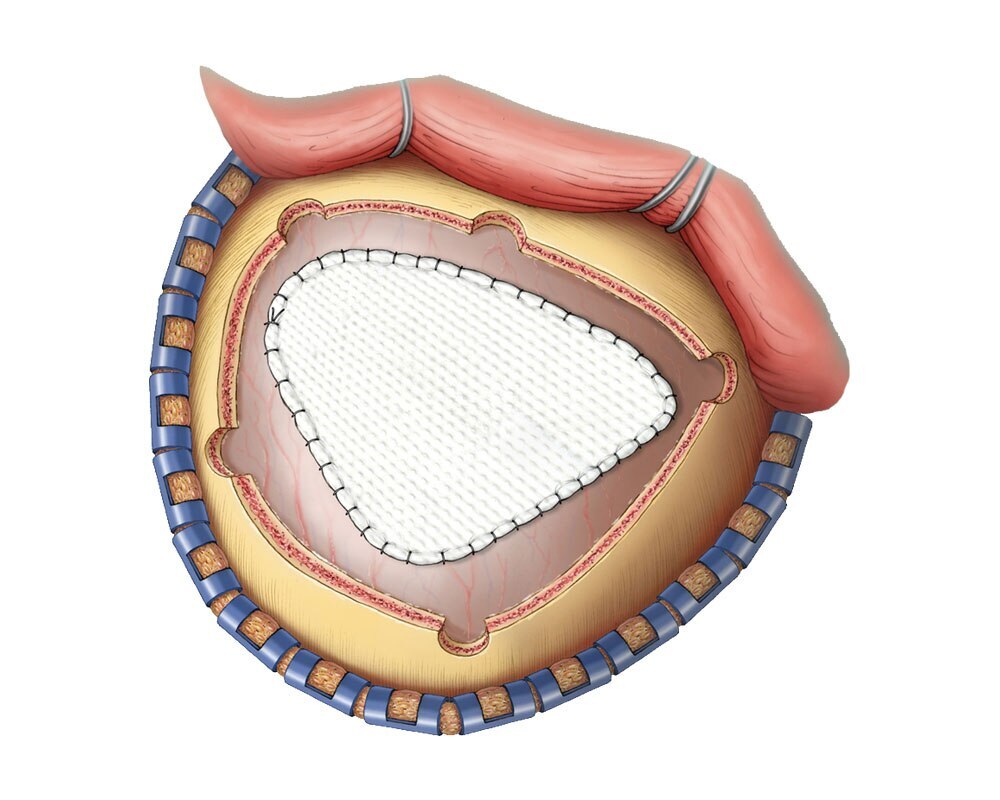 Duragen® Suturable